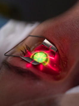 CXL-for-Keratoconus